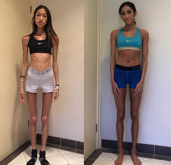 anoreksiya nedir